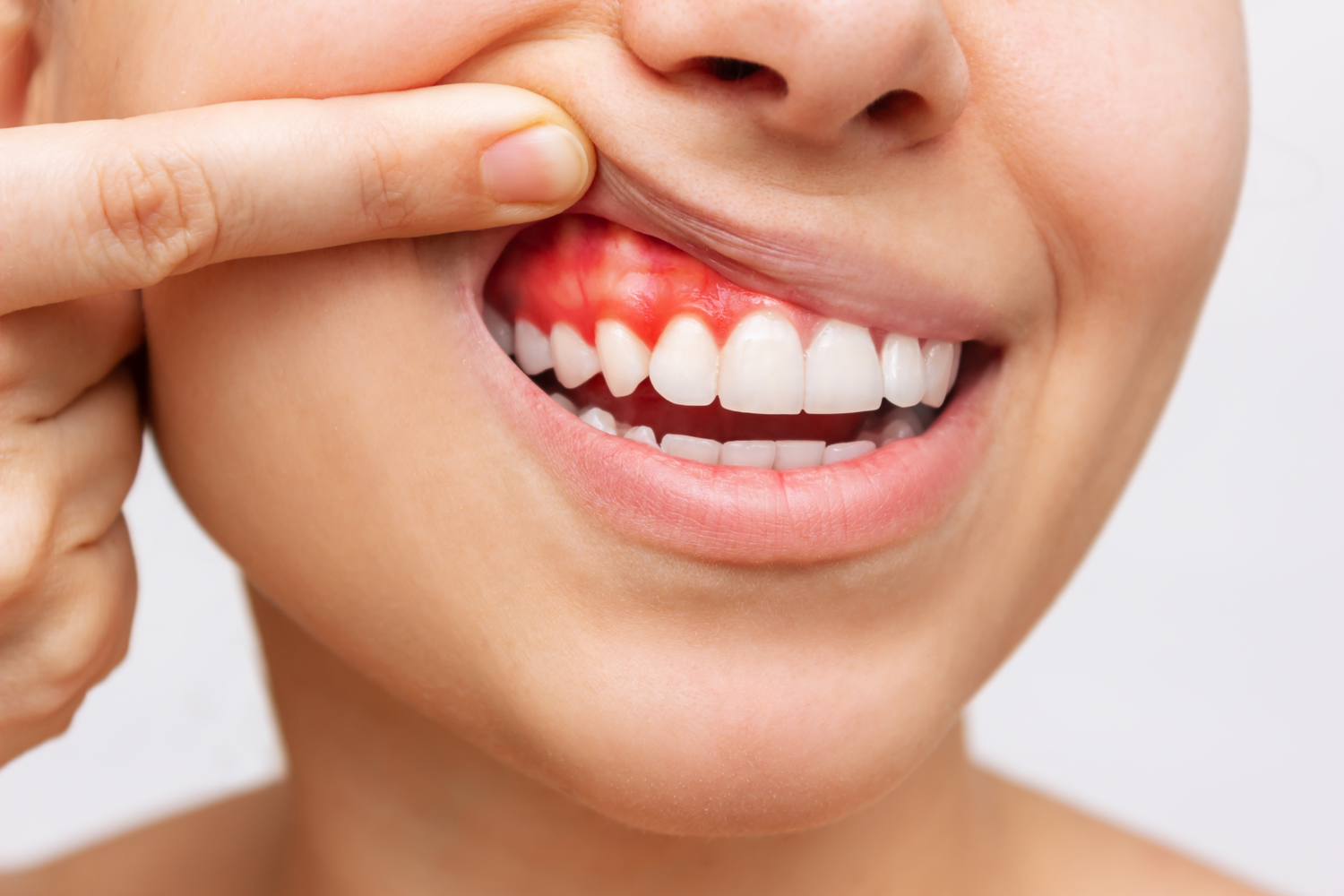 Periodontal Treatment