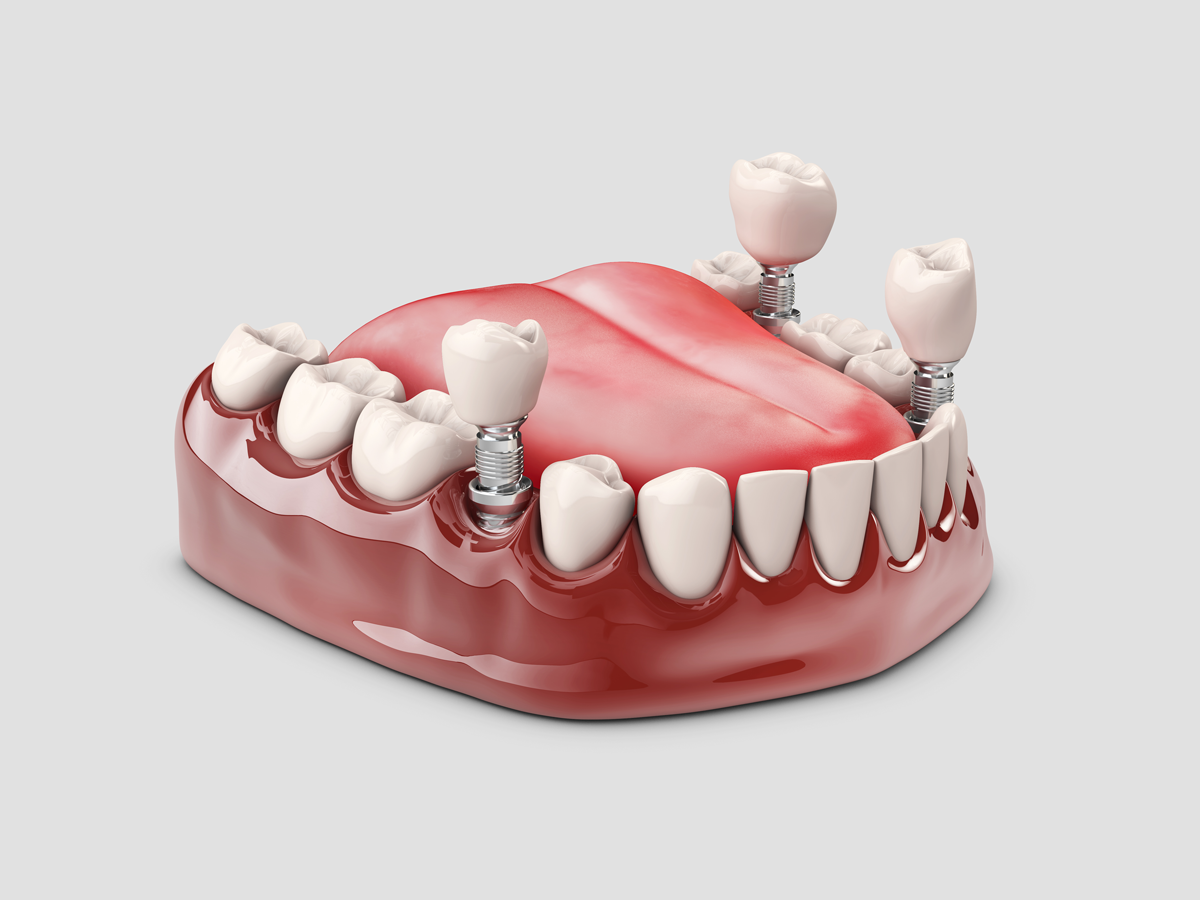 Dental Implant Procedures