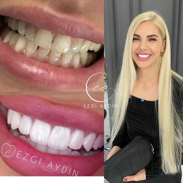 Original before-and-after dental photograph collage 2